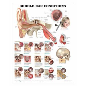 Middle Ear Conditions, flexible laminated poster (20x26)